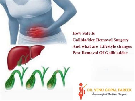 How Safe Is Gallbladder Removal Surgery And what are Lifestyle changes Post Removal Of Gallbladder