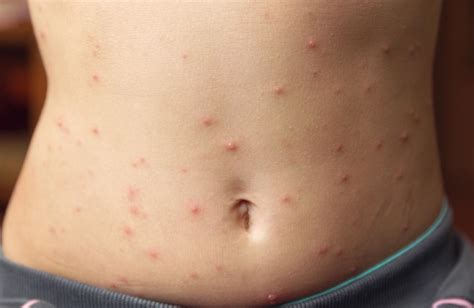 Stomach Rash: Symptoms, Causes & Treatment | Stomach Rash Itchy vs. Not Itchy