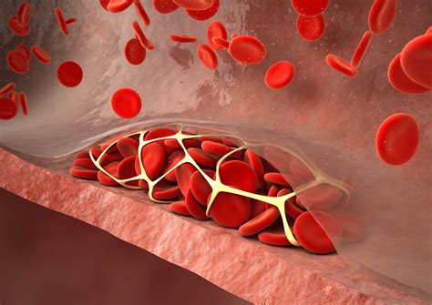 DOACs May Be a Viable Alternative to LMWH in Venous Thromboembolism ...