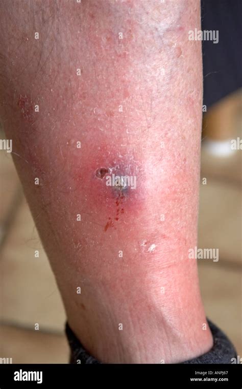 Septic leg wound and scab on shin of middle aged man Stock Photo - Alamy