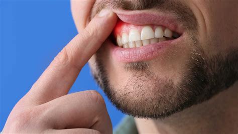Gingivitis y Periodontitis: Enemigos silenciosos de tus dientes - Dentalara