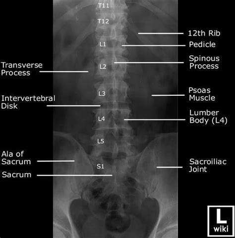 In this image, you may find Lumbar Spine Anterior Posterior View On X-ray With Labeled ...