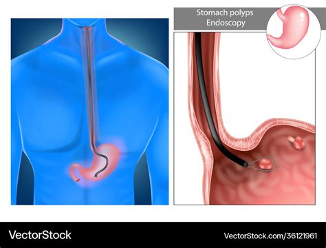 Gastric polyps stomach upper endoscopy Royalty Free Vector