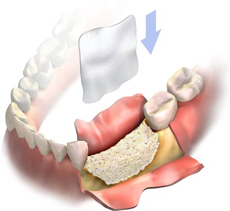 Bone Grafting: Overview, Materials, and Procedure - STOMADENT