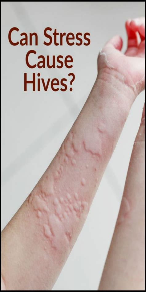 Can Stress Cause Hives? The Answer Is Complicated | Stress causes ...