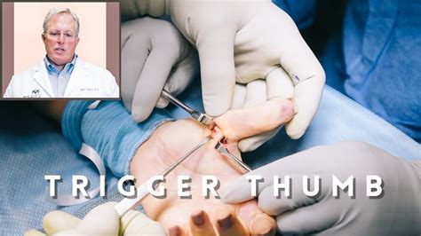 Trigger Thumb Procedure - YouTube