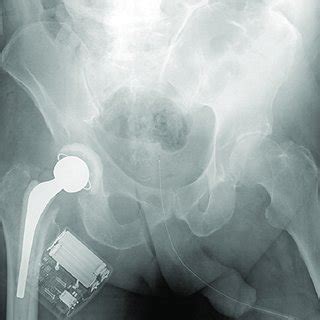 A radiograph showing a hip after resection arthroplasty and antibiotic ...