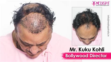 Celebrity Hair Transplant in India | Bollywood Actors Hair Transplant