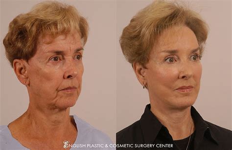 Dermabrasion Before & After | English Plastic & Cosmetic Surgery