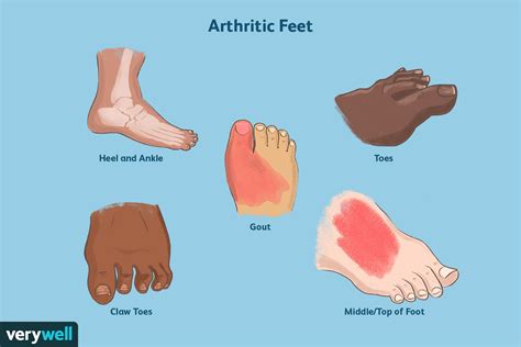 Psoriatic Arthritis Toes