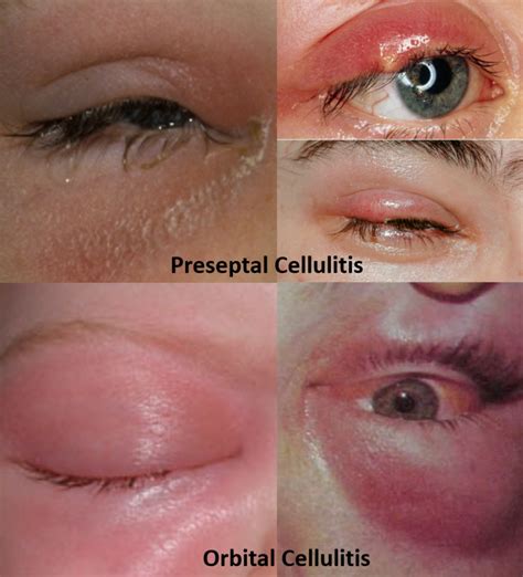 Swollen Eyelid - Know the causes, remedies and alert signs