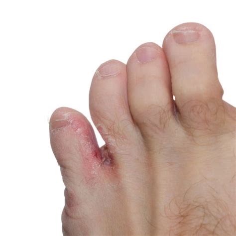 Fungal Infections — Fairfield Podiatry