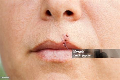 Woman With Stitches On Her Lip Stock Photo - Download Image Now - Adult, Athlete, Beard - iStock