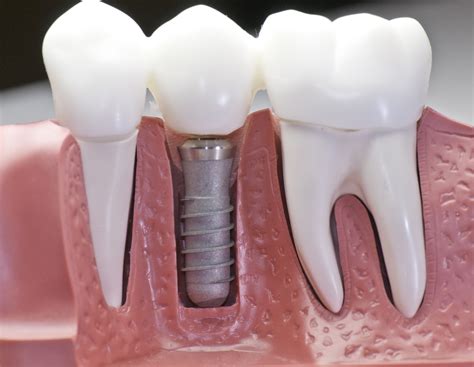 Some Of The Common Myths About Dental Implants - Perevozki NN