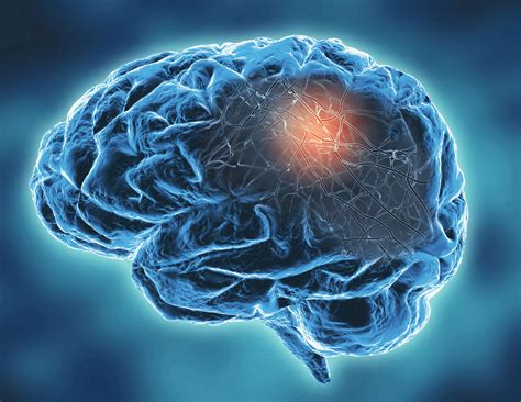 Esclerose Múltipla: entenda a doença da degeneração do sistema nervoso