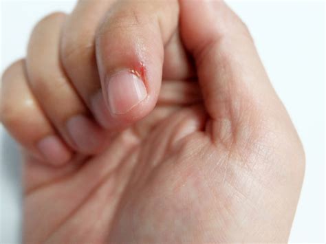 Skin Picking Disorder: A disorder dangerous than nail-biting itself! | What is Skin Picking ...