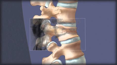 Vertebral Augmentation with an Implant - YouTube