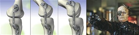 knee replacement alternatives