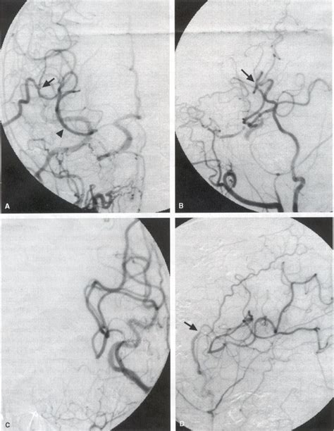 STA-MCA Surgery for Moyamoya Disease