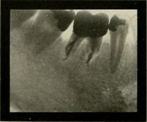 Apicoectomy in Houston TX - Southwest Endodontics