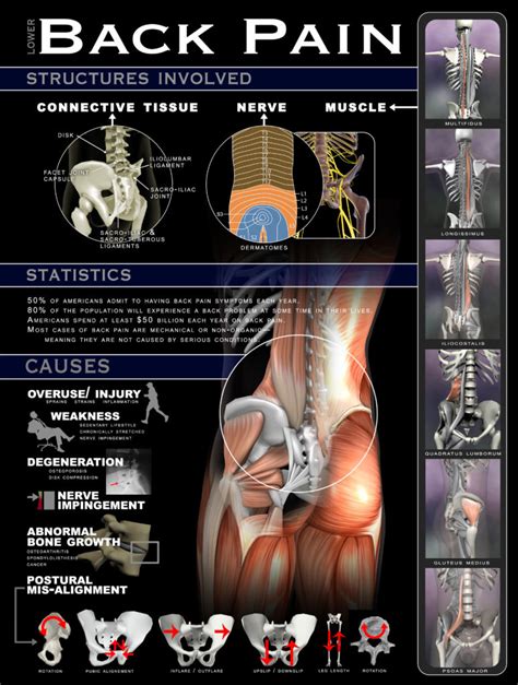 Lower Back Pain: Why, How and Where - Infographic