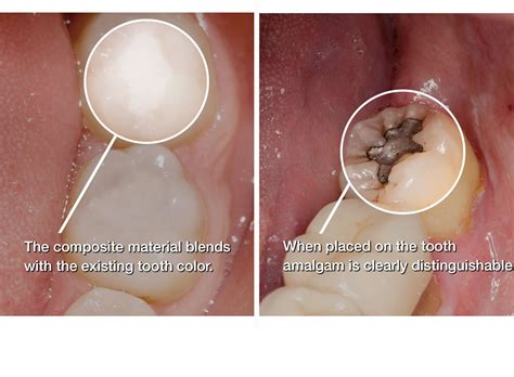 Amalgam Fillings vs Composite