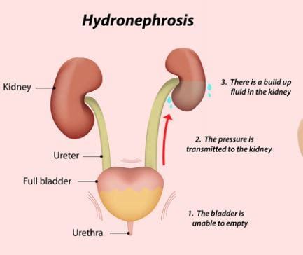 Hydronephrosis - Definition, What is, Symptoms, Treatment, Causes