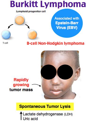 Rosh Review | Burkitt's lymphoma, Oncology nursing, Hematology