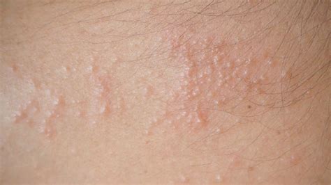 How to identify and treat heat rash quickly in 6 steps | Business ...