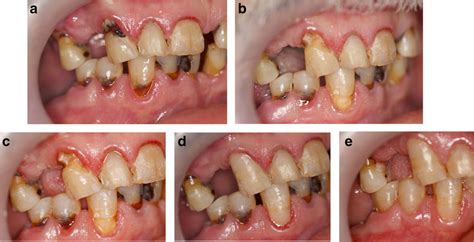 Restoration steps of both groups. a Root surface carious lesions in ...