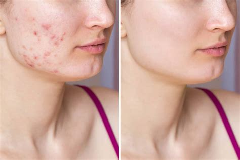 ACNE - Reasons to See a SCI Dermatologist for Acne Treatment | Skin And Cancer Institute