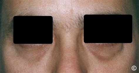 Periorbital hyperpigmentation (syn. dark circles; periorbital hypermelanosis)