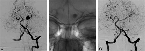 Left vertebral angiogram (A) demonstrates the left PCA aneurysm, which ...