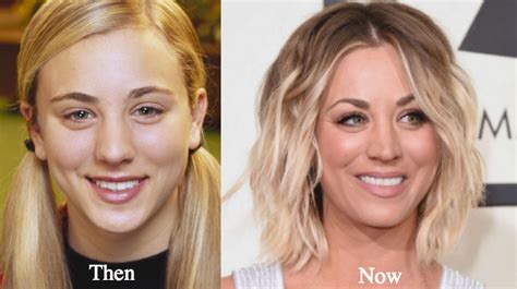 Kaley Cuoco Plastic Surgery Before and After Photos