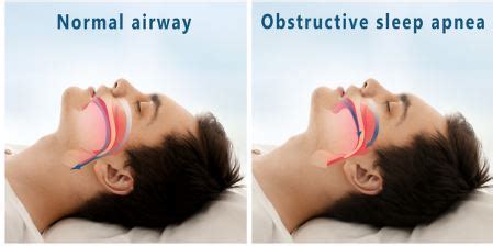 Best Treatment for Sleep Apnea India