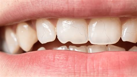 What Are Teeth Craze Lines? Treatment, Causes & Prevention - Tooth Truth