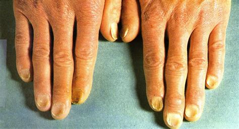 Lunula definition, lunula function & nail problems