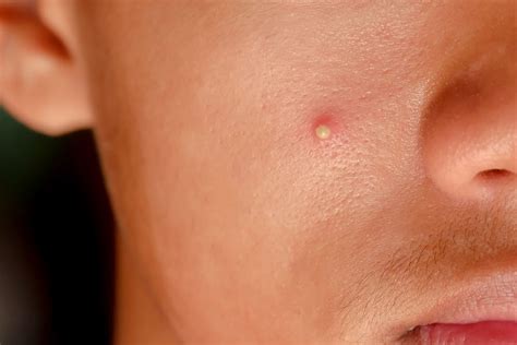Should You Pop Pimples? (And How Else to Get Rid of Acne) - Water's Edge Dermatology