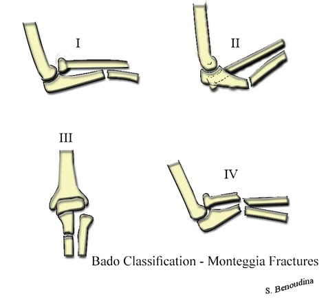 Monteggia fracture - wikidoc