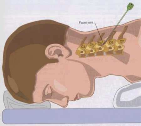 Cervical Facet Joint Nerve Injection