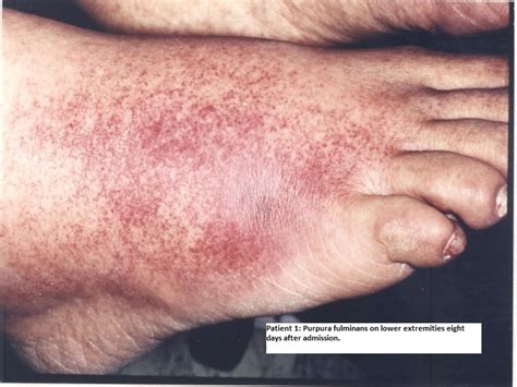 Pseudomonas Aeruginosa Burn Infection