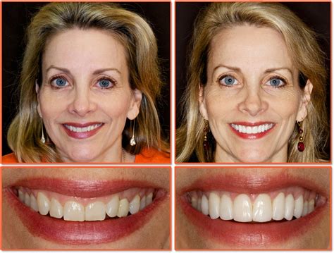 Cosmetic Dentistry – Snowflake Family Dental