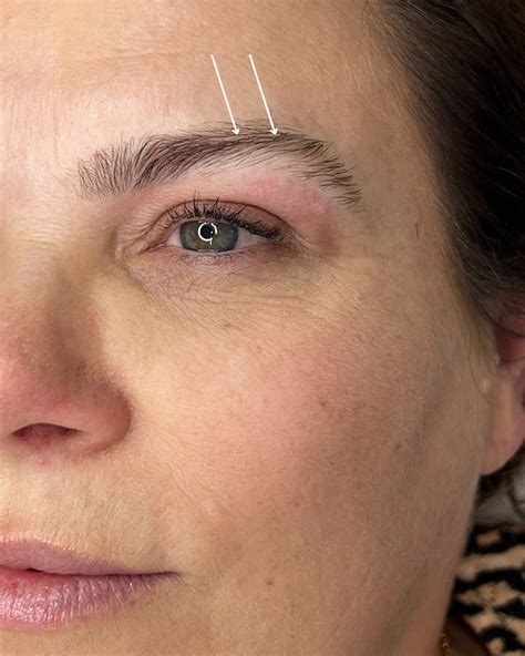 Hypothyroidism Eyebrows