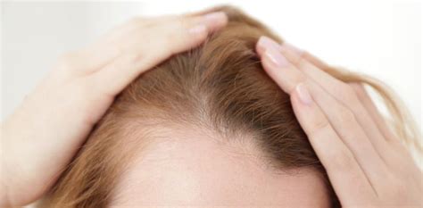 Thyroid Disease and Hair Loss - The Hair Loss Recovery Program