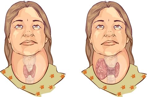 Iodine Deficiency Goitre