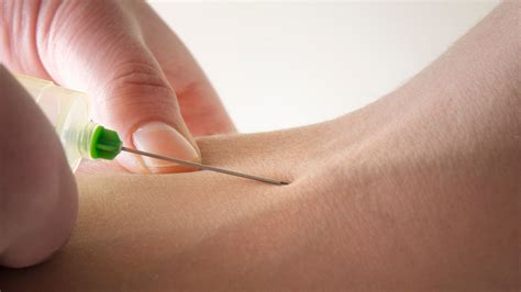 What to Expect After Facet Joint Injections: Recovery Process