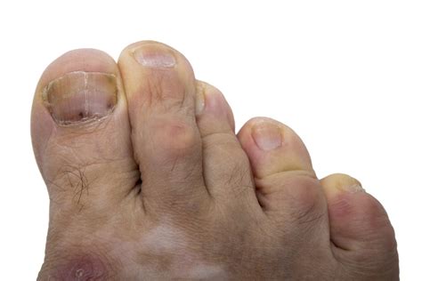 Black Toenail Melanoma Black spot under toenail melanoma | The Pro News