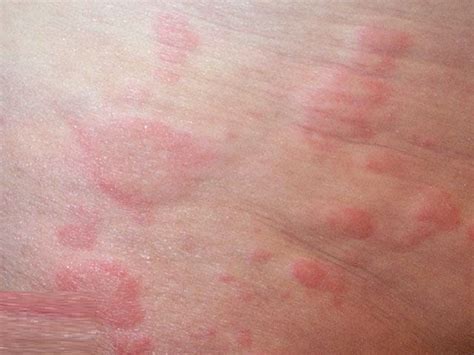 Urticaria – Causes, Symptoms, Treatment