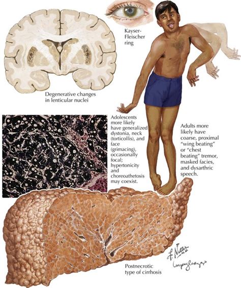 Wilson Disease | Neupsy Key