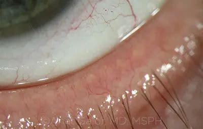 Telangiectasia Eyelid